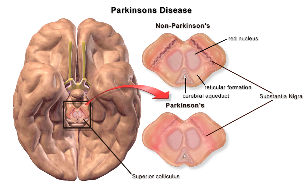 The location of the substantia nigra in the midbrain and the loss of dopaminergic cells in Parkinson's disease.