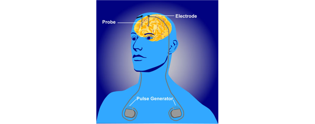 Deep brain stimulation device.