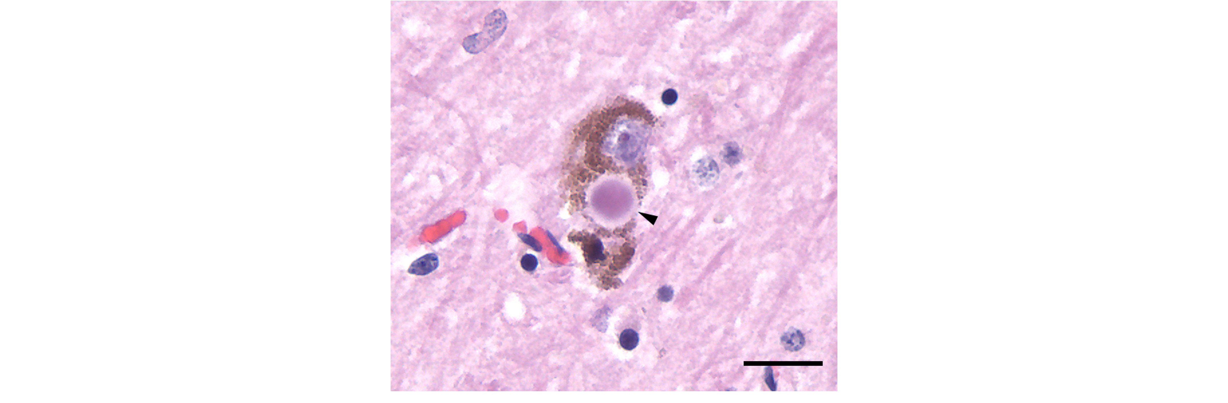 Microscope image of a Lewy body. Details in caption and text.