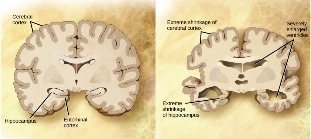 A cross section of a normal brain and the brain of an Alzheimers patient are compared. In the Alzheimers brain, the cerebral cortex is greatly shrunken in size as is the hippocampus. Ventricles, holes in the center and bottom right and left parts of the brain, are also enlarged.