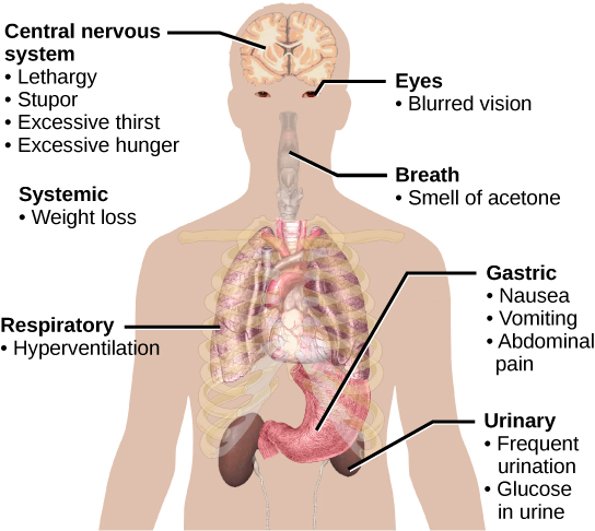 Symptoms of diabetes that affect the central nervous system include excessive thirst, excessive hunger, lethargy and stupor.  It affects the eyes via blurred vision.  A systemic issue is weight loss. It causes breath that smells like acetone, and affects the respiratory system through hyperventilation.  Some of the gastric issues caused are nausea, vomiting, and abdominal pain.  The urinary issues caused include frequent urination, and glucose in the urine.