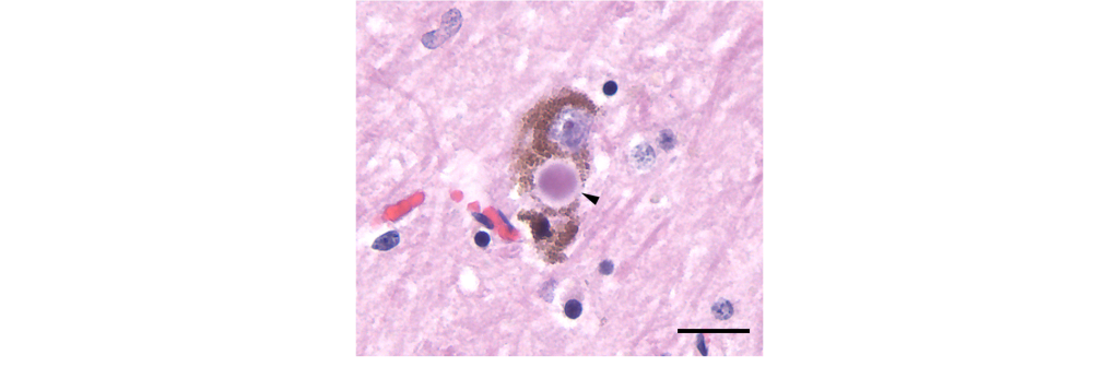 Microscope image of a Lewy body.