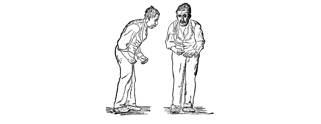 Image showing the stooped posture and shuffling gait of Parkinson's disease. Details in caption and text.